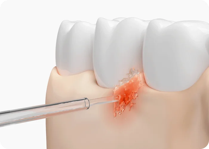 Xiaomi Water Flosser 2 - جهاز تنظيف اللثة والاسنان من شاومي